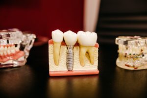 an image showing how dental implants looks like