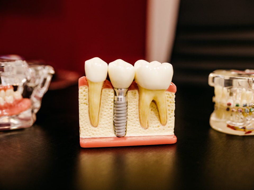 an image showing how dental implants looks like