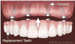 image of dental implant for the upper jaw