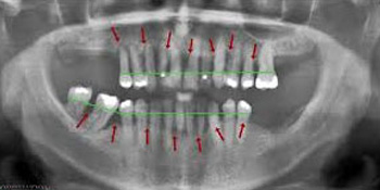 X-ray of a patient’s mouth with dental implants highlighted in red