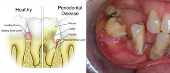 Illustration of healthy teeth and gums compared to teeth and gums with periodontal disease