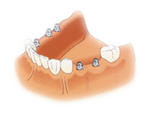 image showing dental implants for complex dental implants treatment | scientific dental implant