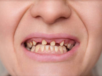 female smile after and before dental crown installation process