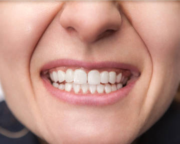female smile after and before dental crown installation process