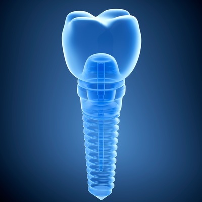 image of a dental implant