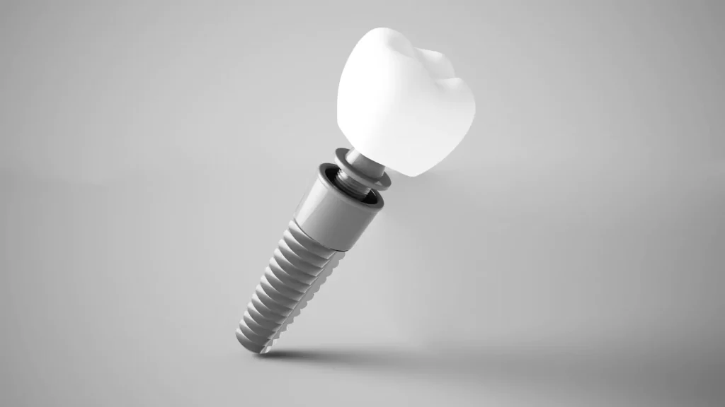 Close-up photograph of a dental implant.