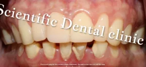 POST COMPOSITE TREATMENT BY DR JOSHUA THOMAS | SMILE MAKEOVER EXPERT | SCIENTIFIC DENTAL CLINIC