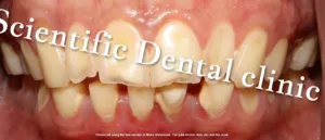 Pre composite | Scientific dental clinic