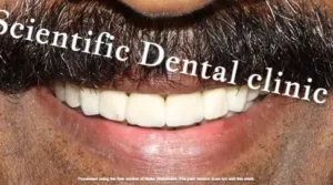 Pre crowns image of a patient | Cosmetic dentistry | Scientific dental clinic