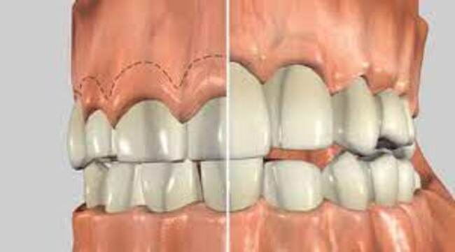 Crown lengthening procedure showing gum reshaping to expose more natural tooth structure at a dental clinic in Kochi. Scientific Dental Clinic