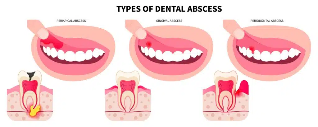Illustration showing types of dental abscess including periapical, gingival, and periodontal abscess with tooth decay and swollen gums.