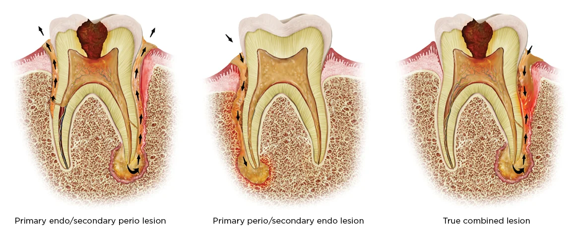 Diagram showing primary endodontic lesion, primary periodontal lesion, and true combined endo-perio lesion affecting tooth pulp, gums, and bone – treated at Scientific Dental Clinic Kochi Kerala.