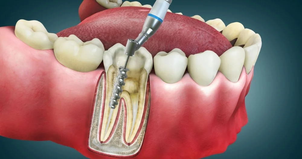 Root canal treatment procedure at Scientific Dental Clinic Kochi showing infected tooth pulp removal and cleaning of root canals to save the natural tooth