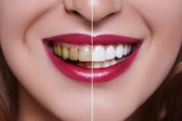 Before and after teeth whitening results showing stain removal and brighter smile treatment for sensitive teeth at Scientific Dental Clinic in Kochi.