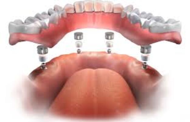 Denture conversion in Kochi showing implant-supported dentures fixed onto dental implants for stable and natural-looking teeth