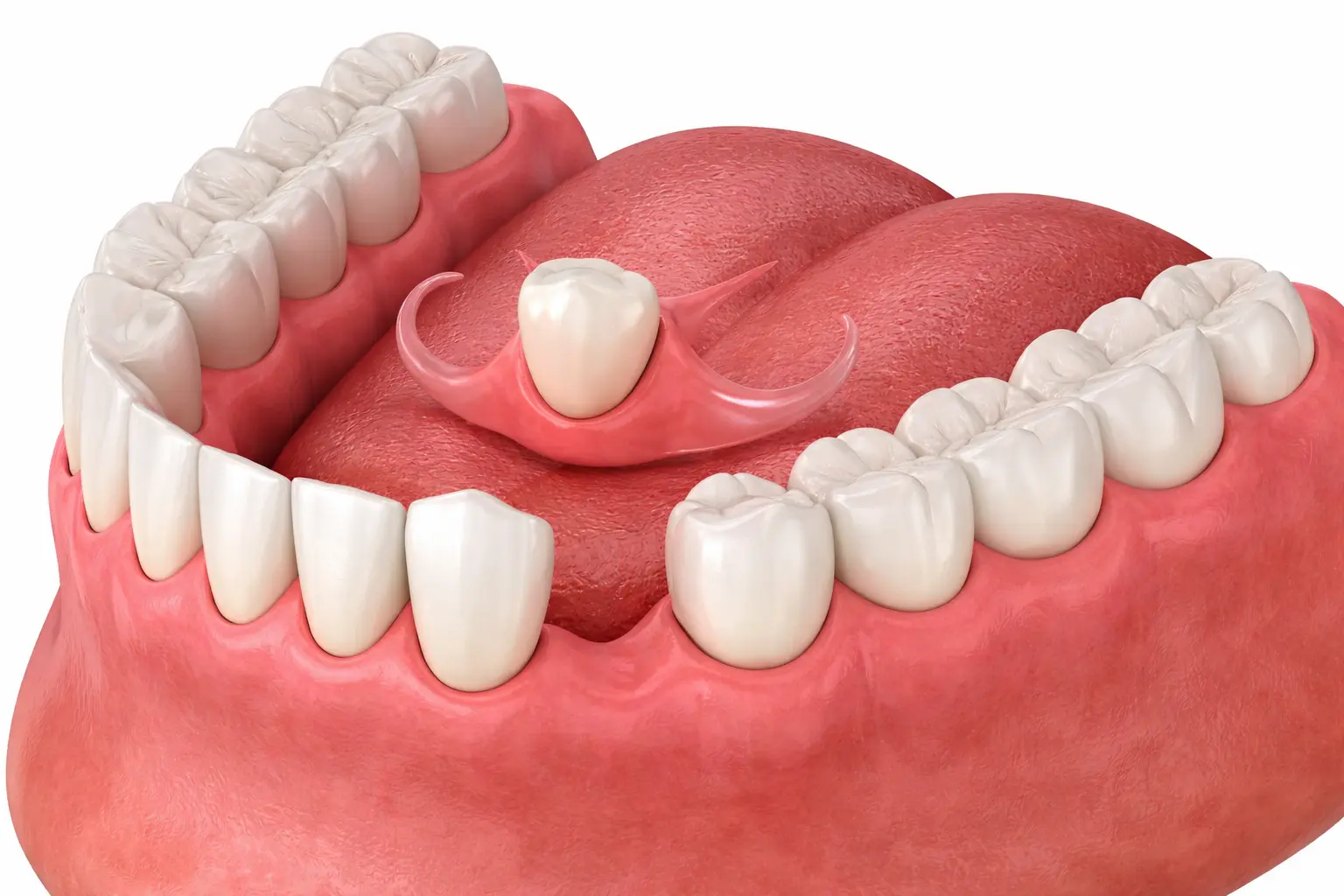 Removable Partial Denture (Flipper)