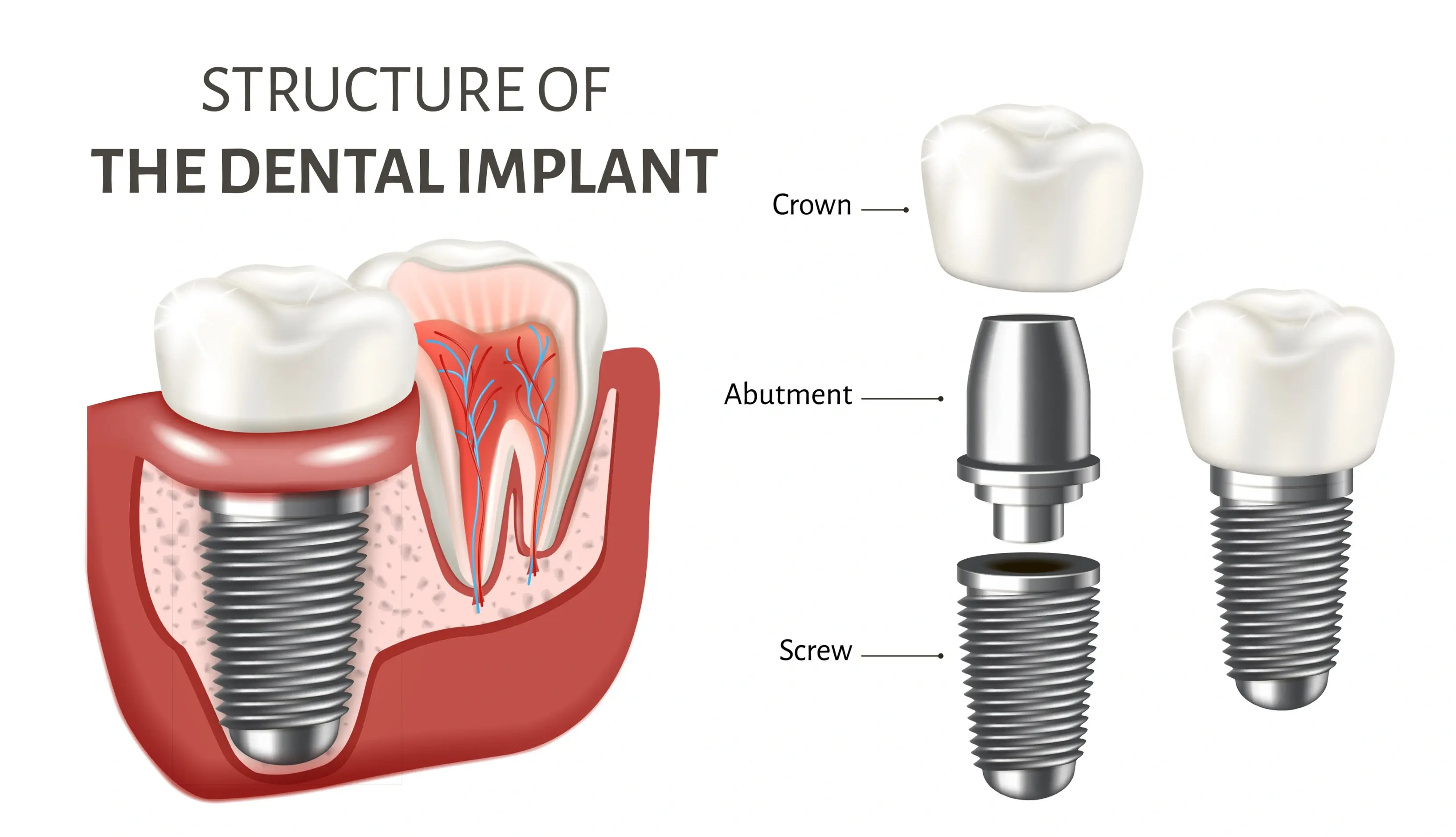 Single Tooth Dental Implants